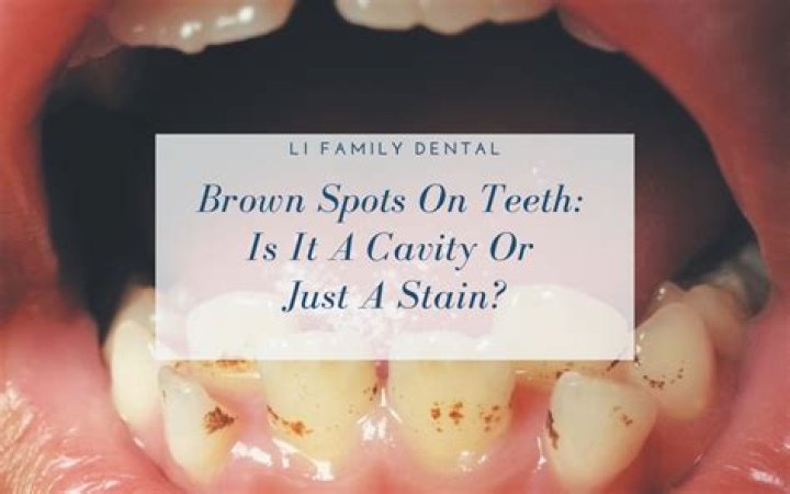 Broken Tooth Brown Inside - How To Discuss